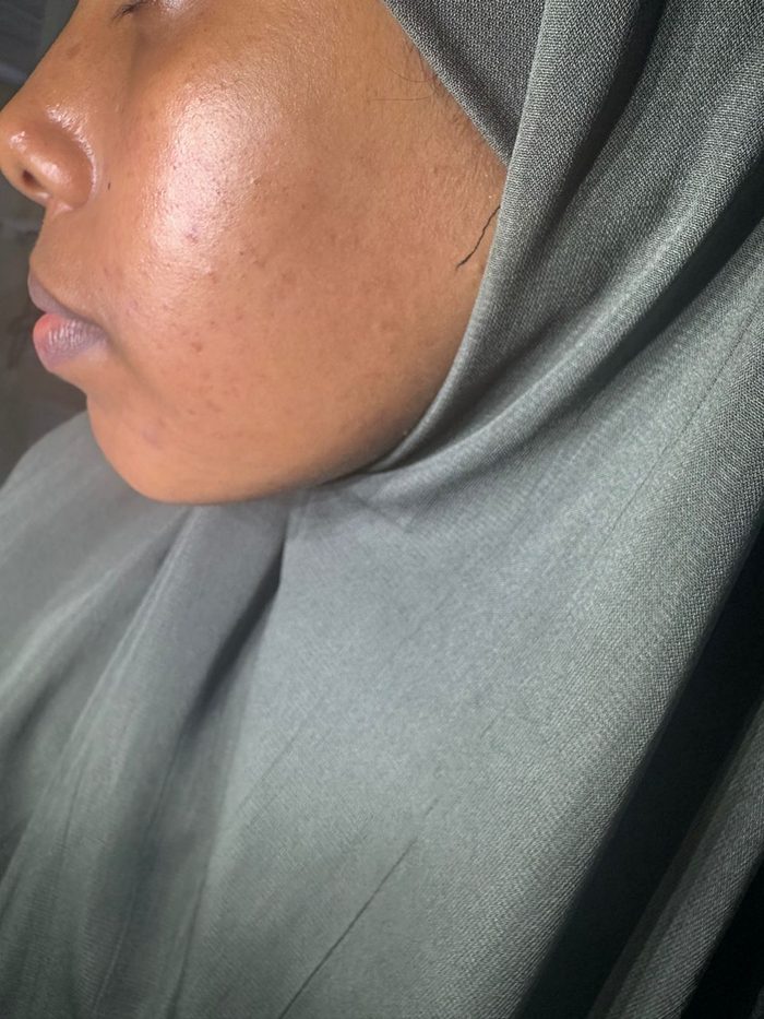 Acne Treatment after result