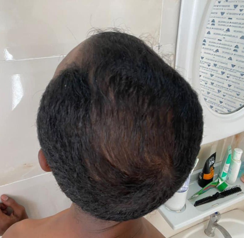 Hair Loss Treatment after result