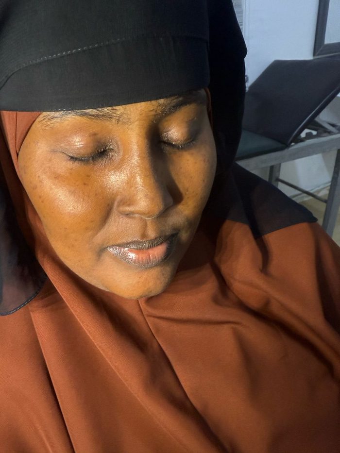 Pigmentation Removal after result