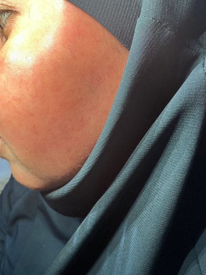 Eczema Care after result